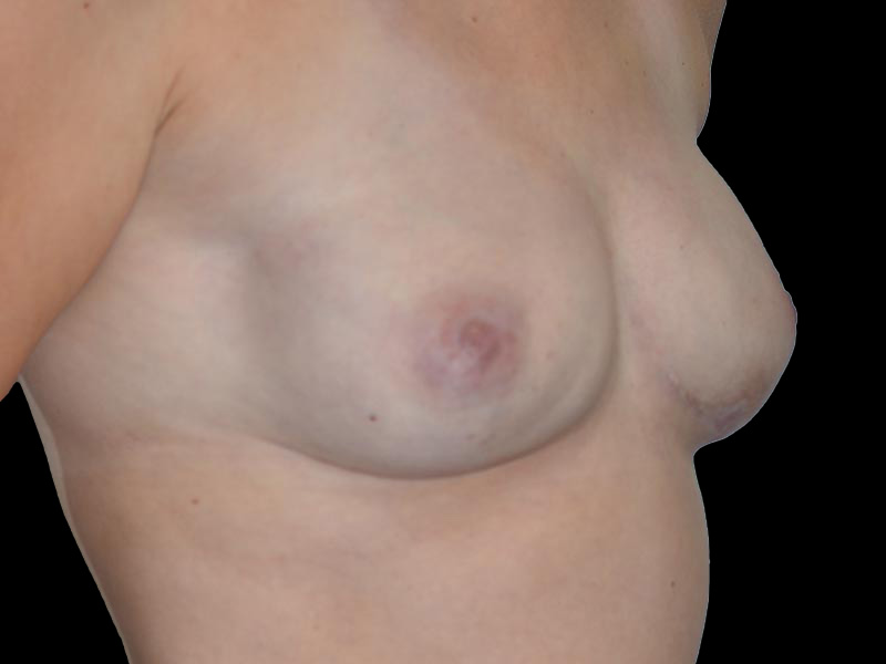 PAP Flap Surgery Before & After Image