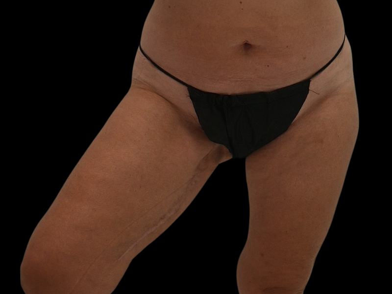PAP Flap Surgery Before & After Image