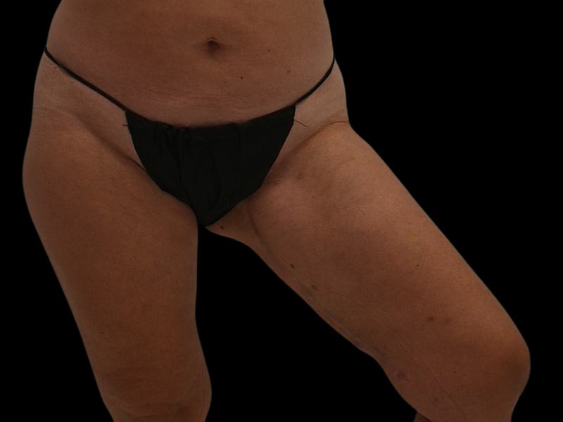 PAP Flap Surgery Before & After Image