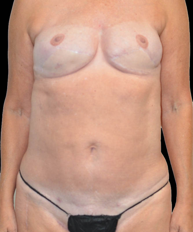 SGAP Before & After Image