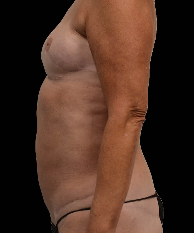 SGAP Before & After Image