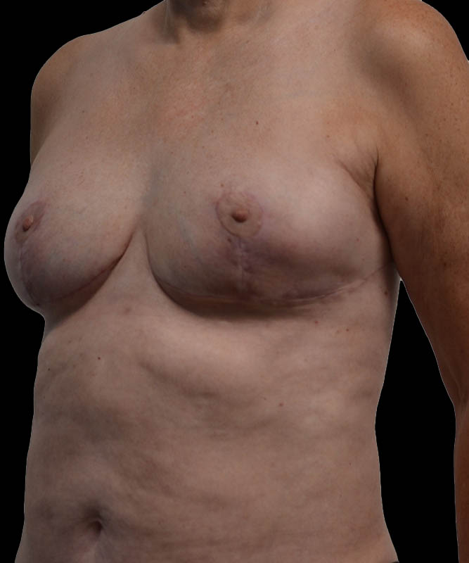 SGAP Before & After Image