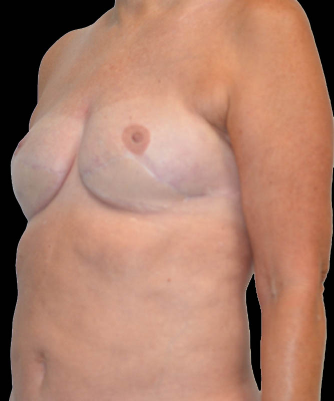 SGAP Before & After Image