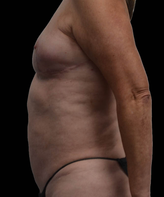 SGAP Before & After Image