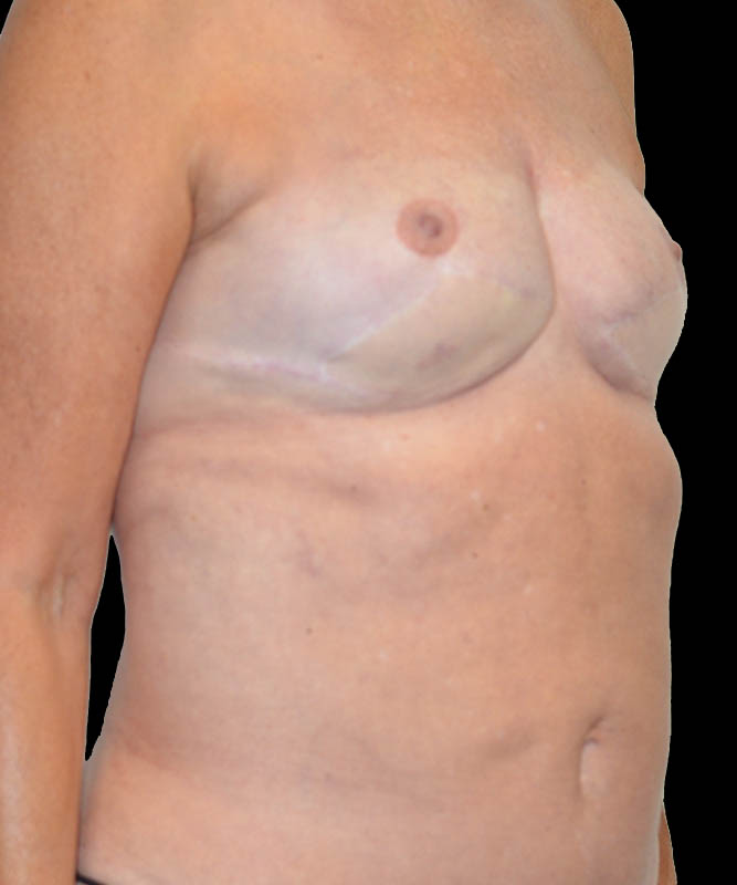 SGAP Before & After Image