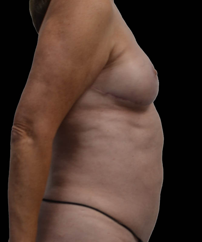 SGAP Before & After Image