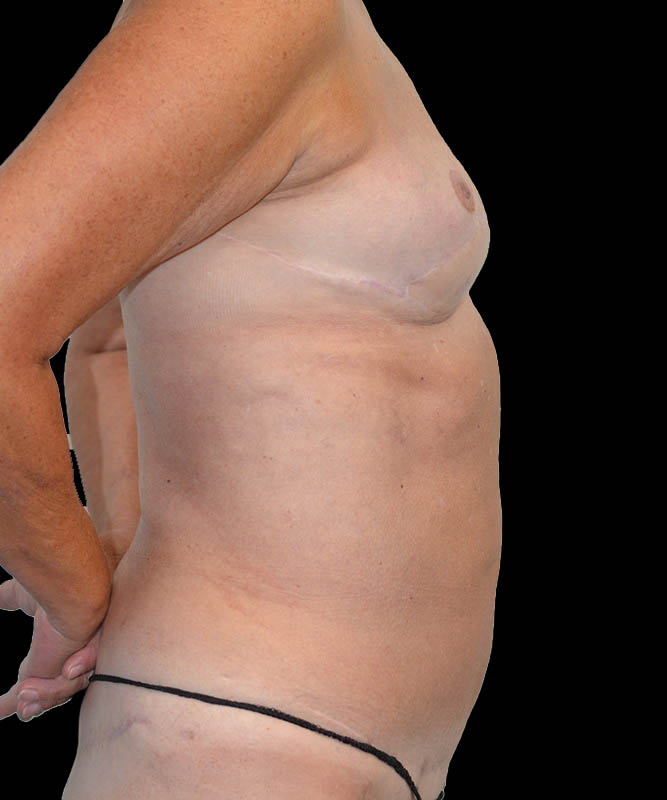 SGAP Before & After Image